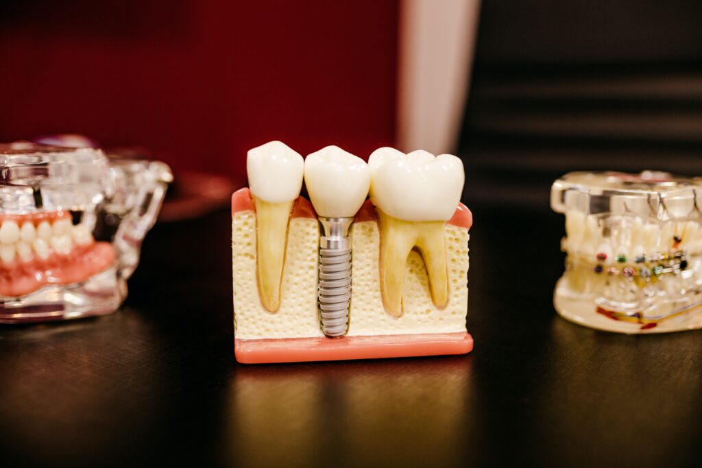 植牙手術人人都可以做嗎？術前必知植牙風險五大重點